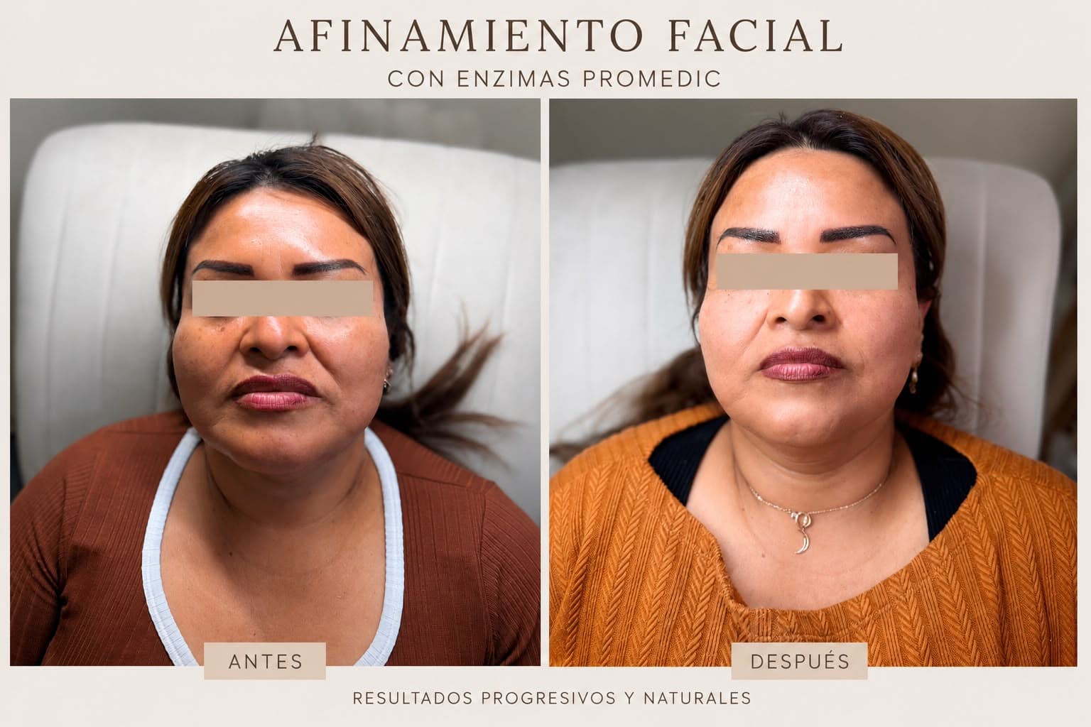 Armonización facial con enzimas