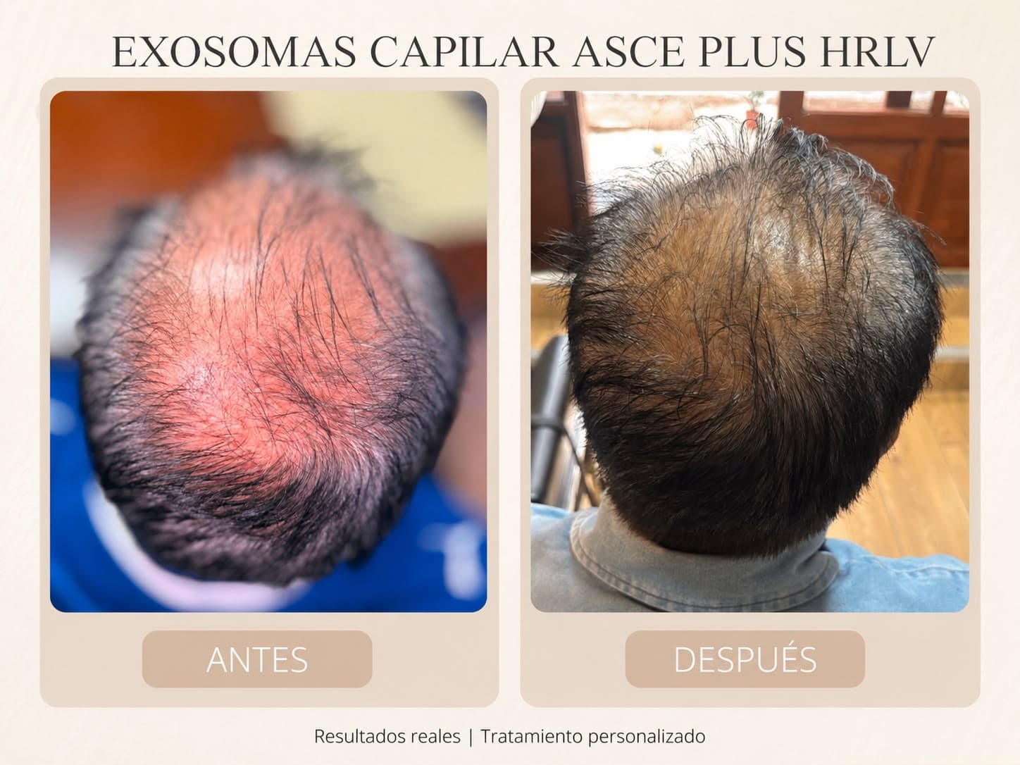Exosomas capilares
