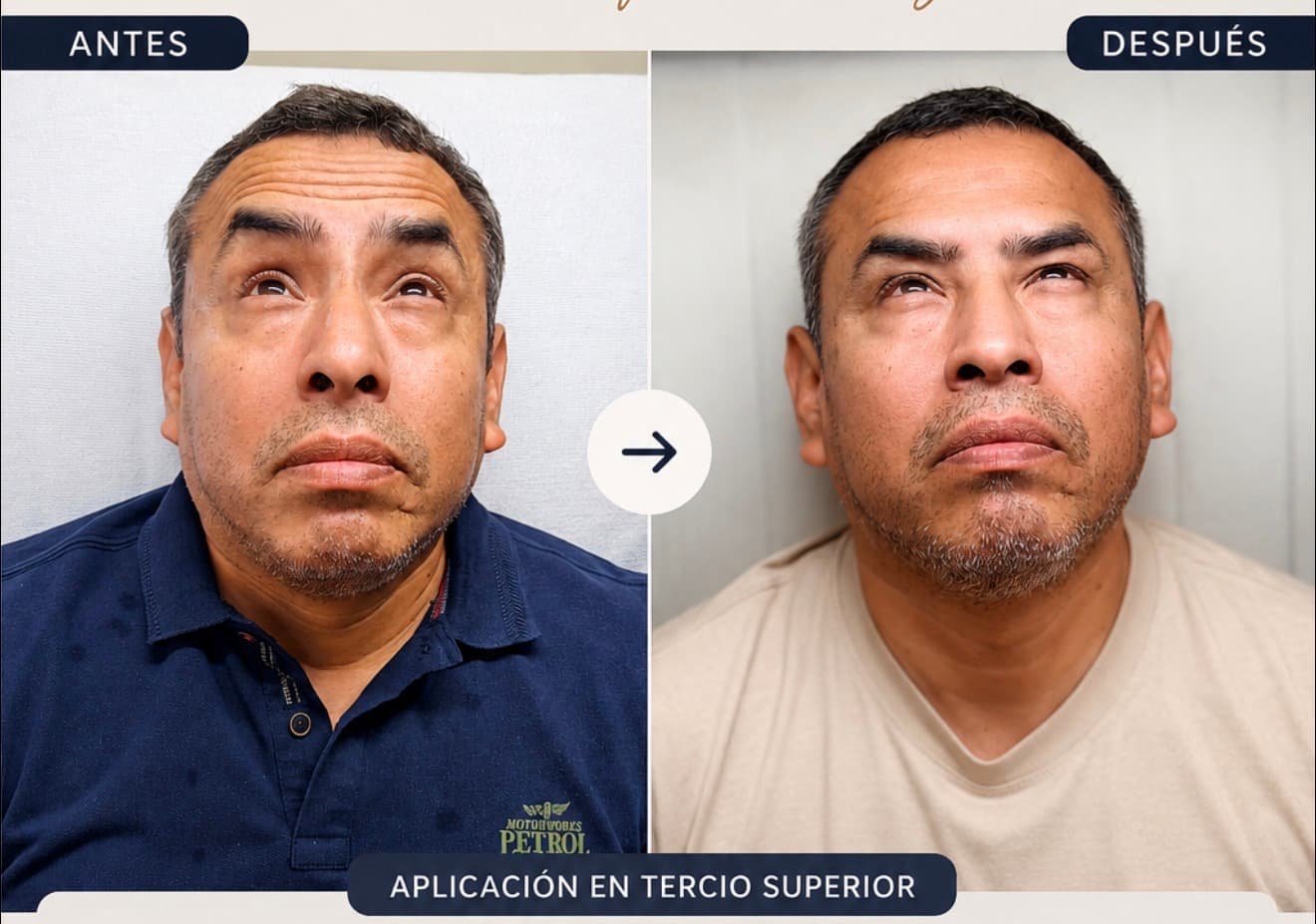 Toxina botulínica